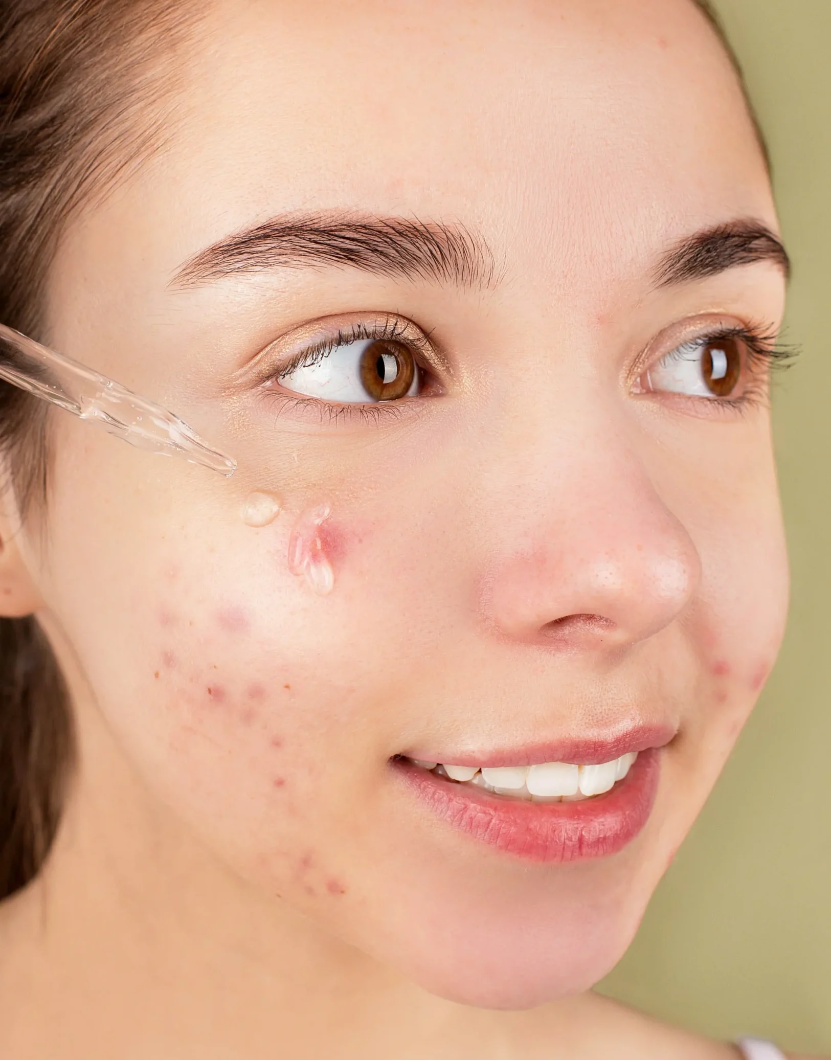 kesalahan cara pakai serum aish acne bekas jerawat di wajah dalam artikel the originote retinol serum review