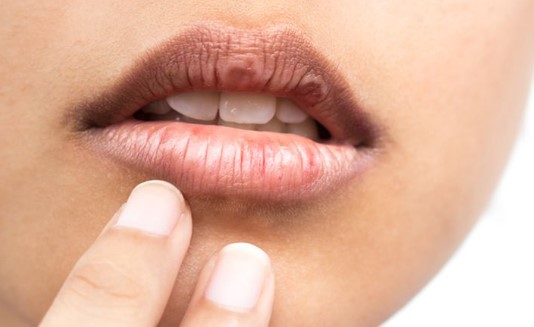 cara mengatasi bibir hitam termudah
