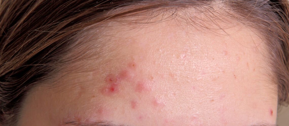 derma angel acne patch review serum avoskin untuk kulit berjerawat cara mengatasi jerawat