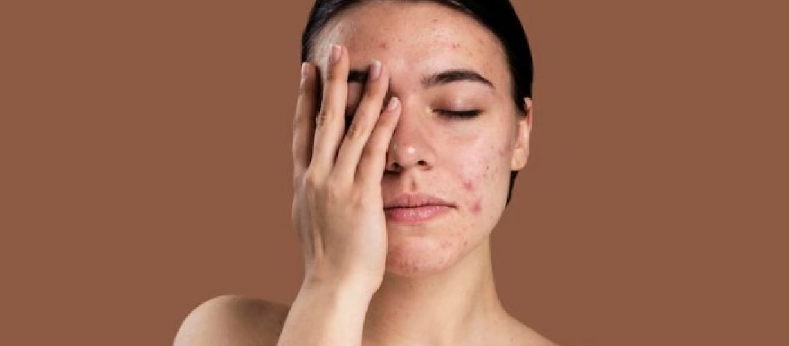 cara mengatasi jerawat Tips Cara Cek Alergi Menggunakan Skincare Baru yang Tepat!tasi skin barrier yang bermasalah bruntusan cara menghilangkan jerawat pasir terampuh